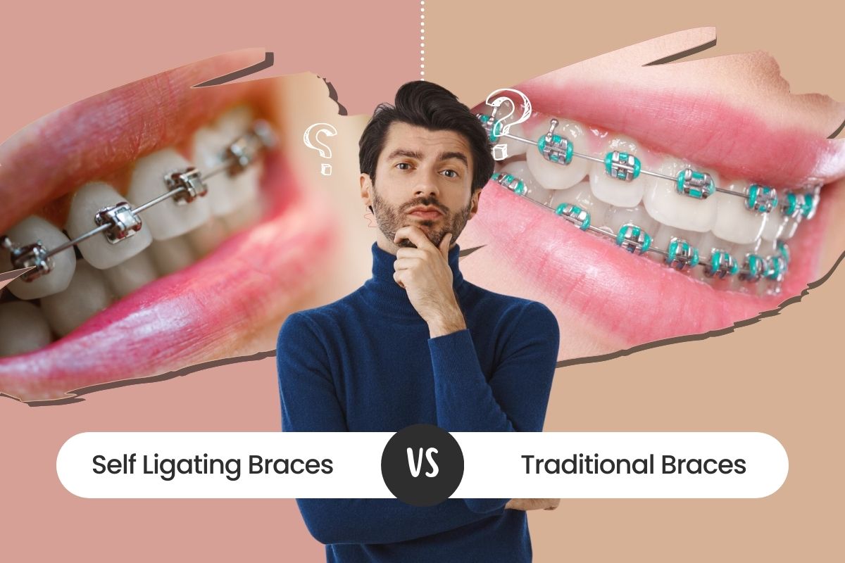 Self-Ligating Braces vs. Traditional Braces