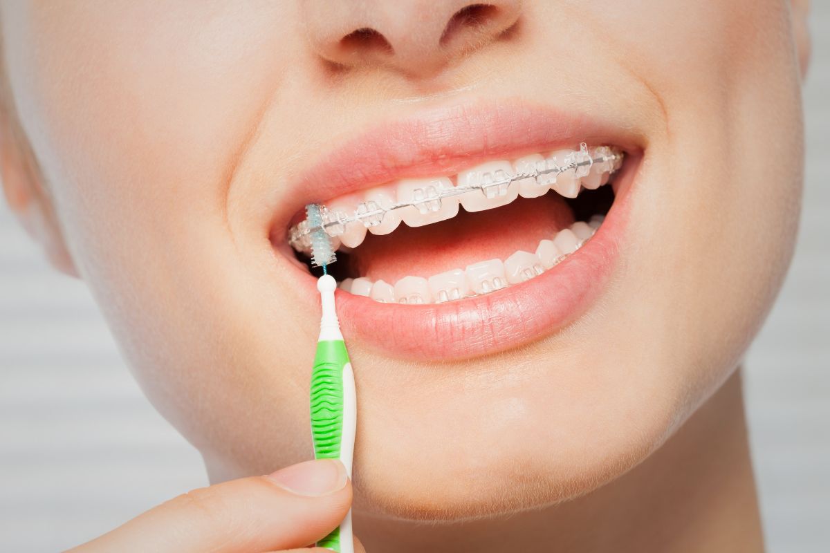 Invisible Braces in Wanjari Nagar