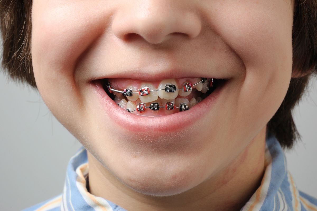 Kids Braces Treatment in Wanjari Nagar