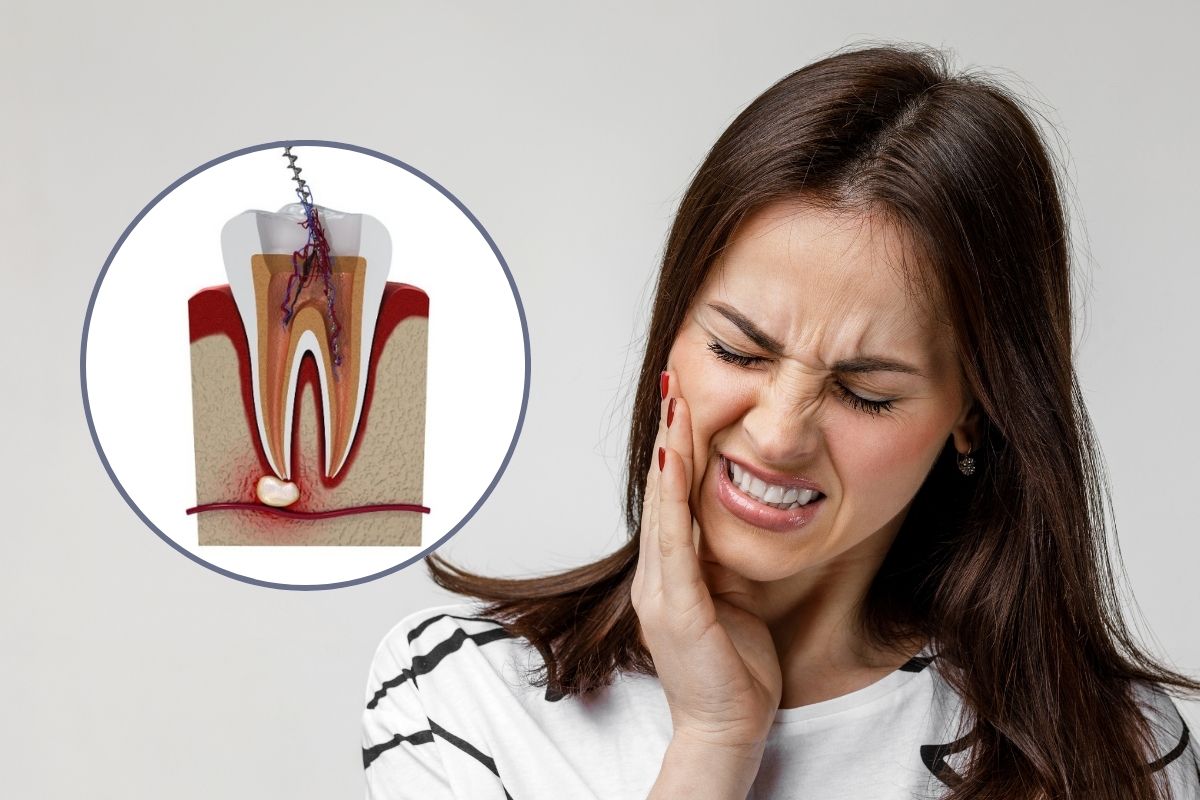 Root Canal Treatment in Wanjari Nagar