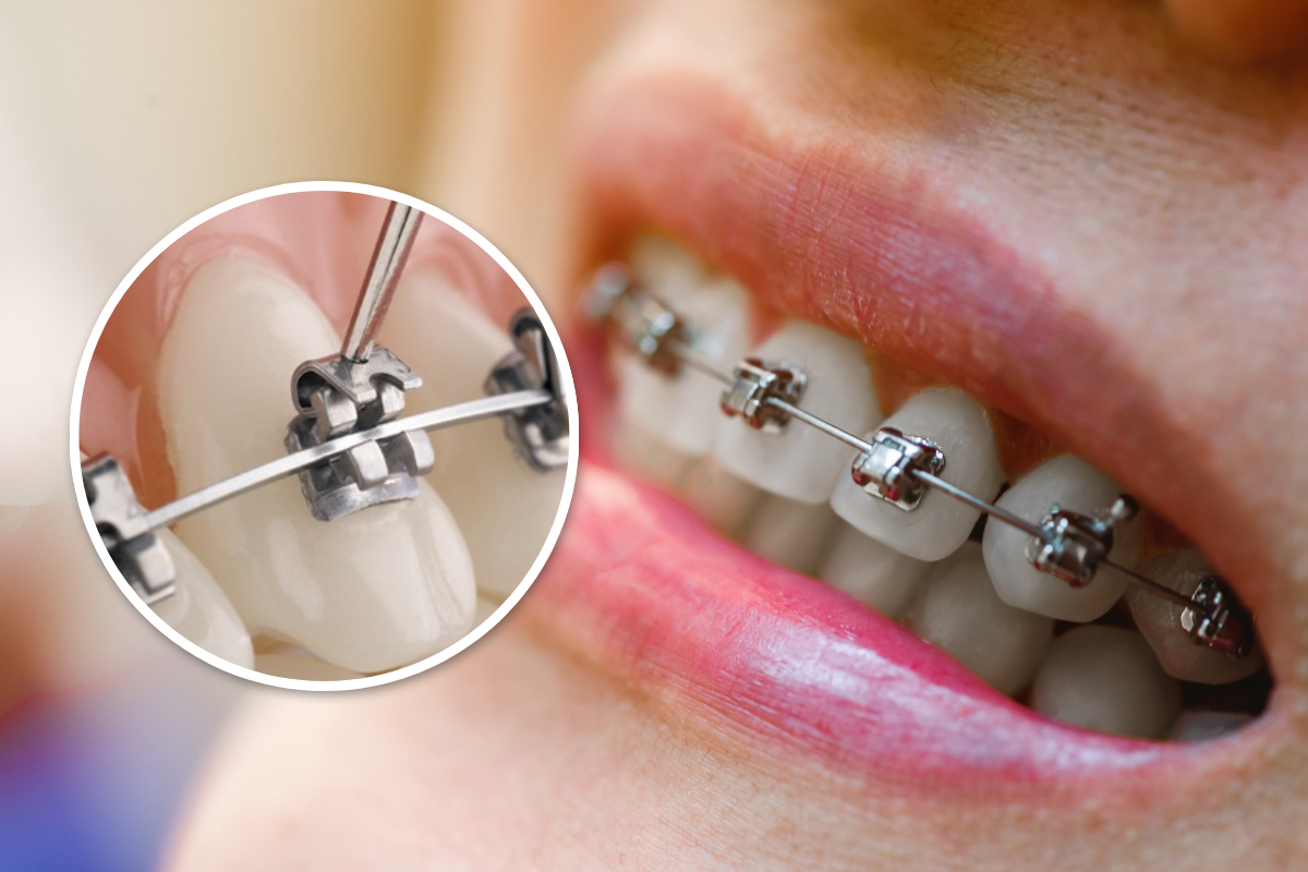 Self ligating Braces Treatment in Wanjari Nagar