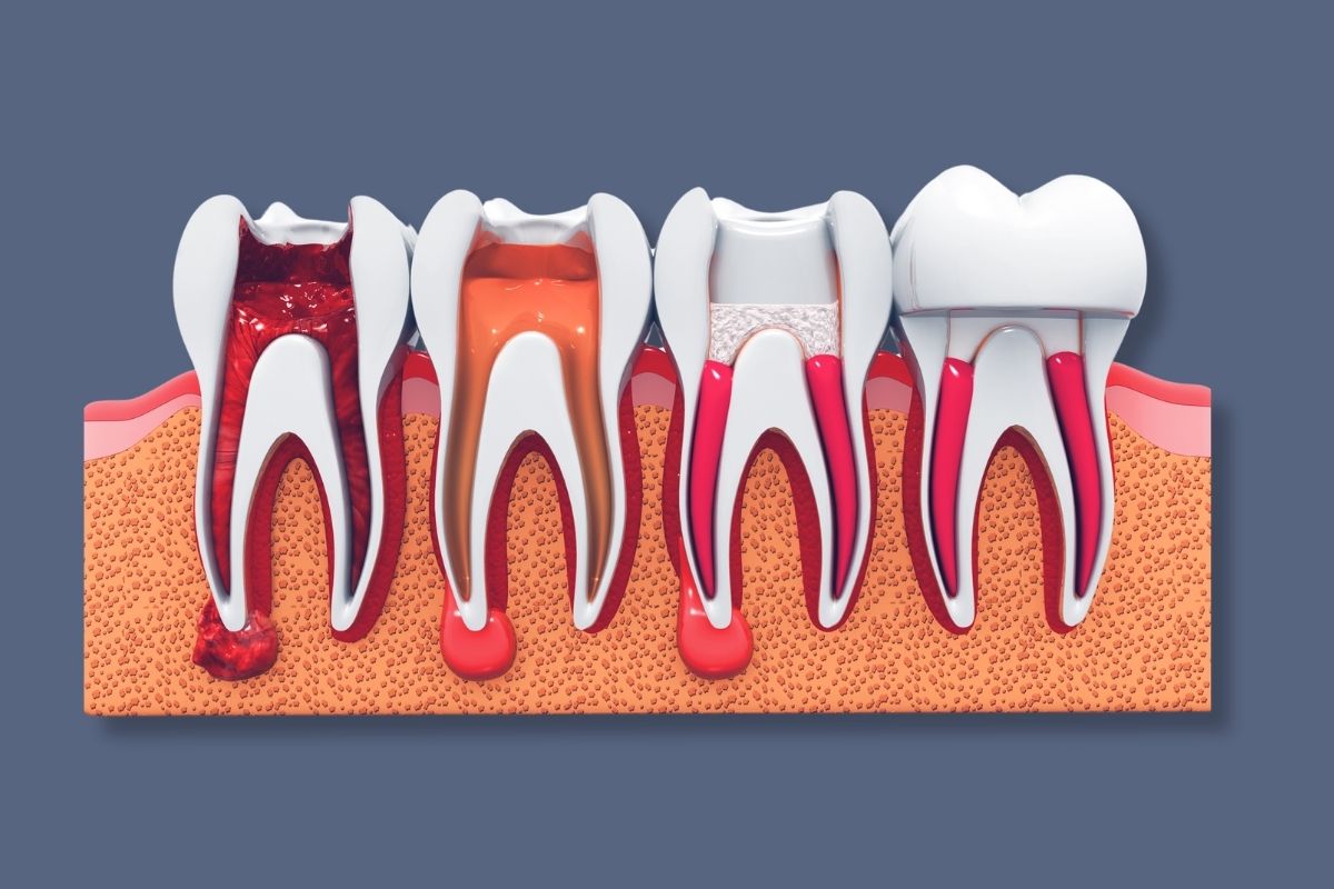 Single Sitting Root Canal Treatment in Wanjari Nagar