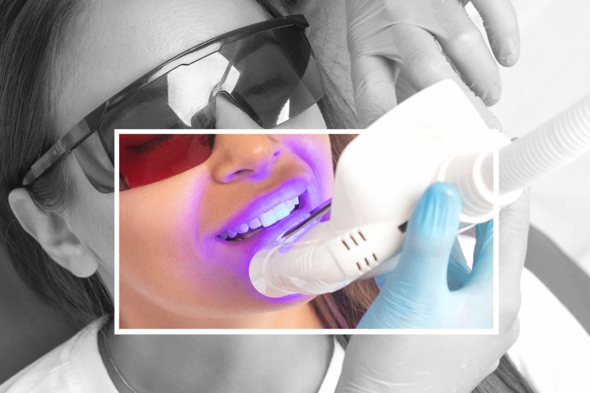 Teeth-Whitening in Wanjari Nagar