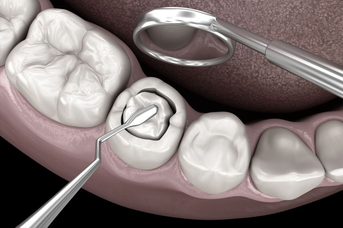 Tooth-colored-fillings in Wanjari Nagar